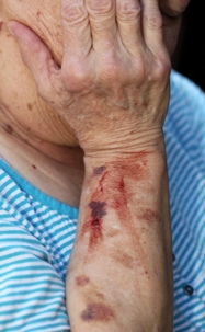 Close-up of an elderly woman's bloody arm