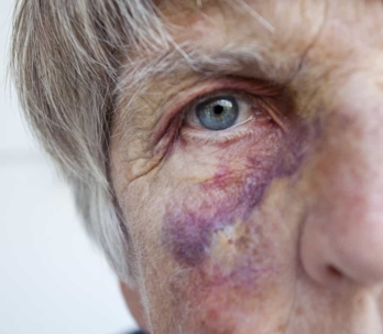 Close-up of an elderly woman's bruised eye